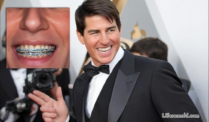 Tom Cruise smiling confidently with ceramic braces during the Minority Report premiere era.