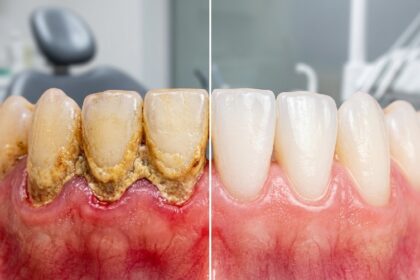 Close-up of severe calculus bridge tartar buildup on lower front teeth compared with clean healthy teeth